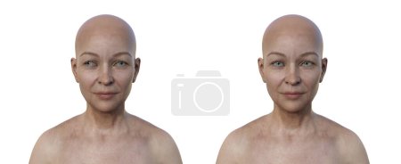 Foto de Una mujer con exotropía y la misma persona sana. Ilustración 3D que demuestra la desalineación de los ojos hacia afuera. - Imagen libre de derechos