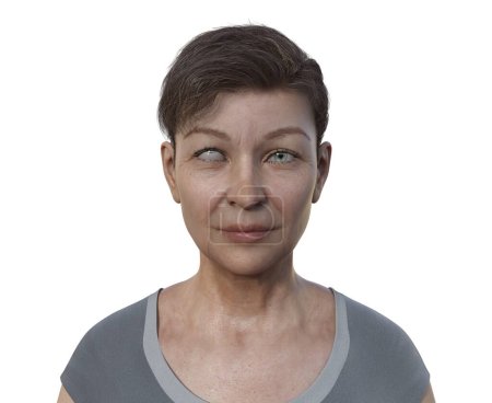 Foto de Una mujer con hipertropía, ilustración 3D con desalineación del ojo hacia arriba. - Imagen libre de derechos