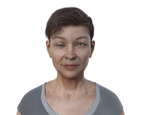 Téléchargez les photos : Une femme avec hypotropie, illustration 3D montrant un décalage oculaire vers le bas. - en image libre de droit