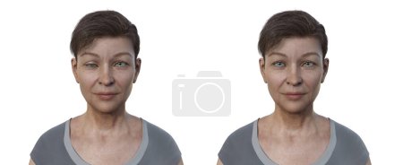 Photo for A woman with hypotropia, 3D illustration displaying downward eye misalignment. - Royalty Free Image