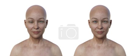 Foto de Una mujer con hipotropía, ilustración 3D mostrando una desalineación del ojo hacia abajo. - Imagen libre de derechos