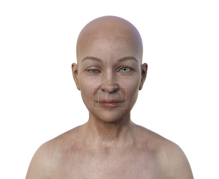 Foto de Una mujer con hipotropía, ilustración 3D mostrando una desalineación del ojo hacia abajo. - Imagen libre de derechos