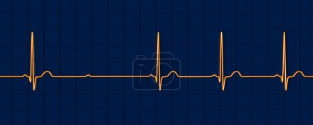 Photo for 3D illustration visualizing an ECG with 2nd degree AV block (Mobitz 2), highlighting abnormal electrical conduction in the heart rhythm. - Royalty Free Image