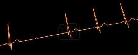 Ilustración 3D visualizando un ECG con bloqueo AV de segundo grado (Mobitz 2), destacando una conducción eléctrica anormal en el ritmo cardíaco.