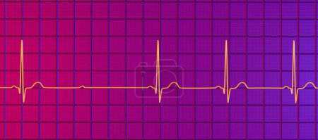 Foto de Ilustración 3D visualizando un ECG con bloqueo AV de segundo grado (Mobitz 2), destacando una conducción eléctrica anormal en el ritmo cardíaco. - Imagen libre de derechos