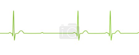 Foto de Ilustración 3D visualizando un ECG con bloqueo AV de segundo grado (Mobitz 2), destacando una conducción eléctrica anormal en el ritmo cardíaco. - Imagen libre de derechos