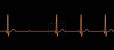 Photo for 3D illustration visualizing an ECG with 2nd degree AV block (Mobitz 2), highlighting abnormal electrical conduction in the heart rhythm. - Royalty Free Image
