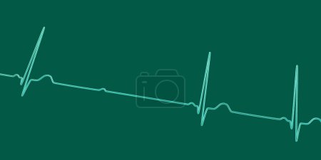 Téléchargez les photos : Illustration 3D visualisant un ECG avec bloc AV au 2ème degré (Mobitz 2), mettant en évidence une conduction électrique anormale dans le rythme cardiaque. - en image libre de droit
