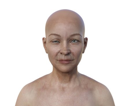 Foto de Ilustración conceptual 3D que representa a una mujer con ptosis, una condición de párpados caídos, que afecta a la visión y la estética facial. - Imagen libre de derechos