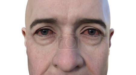 Foto de Ilustración conceptual en 3D que retrata a una persona con los ojos secos, una condición marcada por una producción insuficiente de lágrimas que causa molestias e irritación. - Imagen libre de derechos