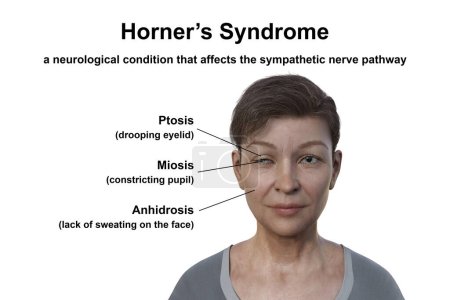 Foto de Ilustración científica en 3D con una mujer con síndrome de Horner, que representa la ptosis, miosis y anhidrosis debido a la interrupción del nervio simpático. - Imagen libre de derechos