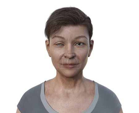Foto de Ilustración científica en 3D con una mujer con síndrome de Horner, que representa la ptosis y la miosis debido a la interrupción simpática del nervio. - Imagen libre de derechos