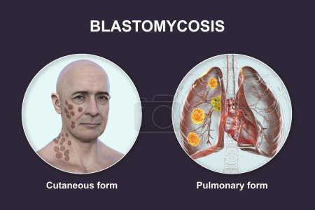 Clinical forms of blastomycosis. Cutaneous and pulmonary blastomycosis, 3D illustration.