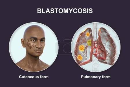 Photo for Clinical forms of blastomycosis. Cutaneous and pulmonary blastomycosis, 3D illustration. - Royalty Free Image