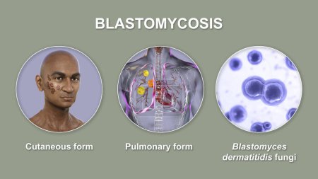 Foto de Formas clínicas de blastomicosis. Blastomicosis cutánea y pulmonar y vista de cerca de hongos Blastomyces dermatitidis, ilustración 3D. - Imagen libre de derechos