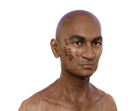Photo for 3D illustration depicting a man with multiple face and neck lesions, showcasing cutaneous blastomycosis, caused by Blastomyces dermatitidis fungus. - Royalty Free Image