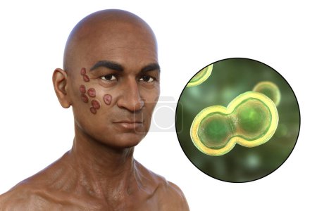 Photo for 3D illustration depicting a man with multiple face and neck lesions, showcasing cutaneous blastomycosis, and close-up view of Blastomyces dermatitidis fungi. - Royalty Free Image