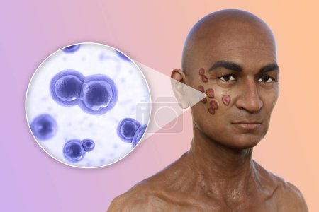 Photo for 3D illustration depicting a man with multiple face and neck lesions, showcasing cutaneous blastomycosis, and close-up view of Blastomyces dermatitidis fungi. - Royalty Free Image