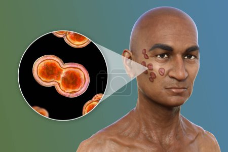 3D-Illustration eines Mannes mit multiplen Gesichts- und Halsverletzungen, Darstellung der kutanen Blastomykose und Nahaufnahme von Blastomyces dermatitidis-Pilzen.