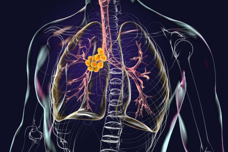 Foto de Ilustración 3D intrincada que revela linfadenitis mediastínica dentro de un cuerpo humano transparente. - Imagen libre de derechos