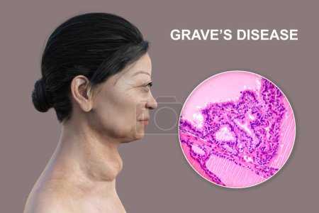 Photo for A 3D illustration of a female patient with enlarged thyroid gland and exophthalmos, alongside with a micrograph image of thyroid tissue affected by toxic goiter. - Royalty Free Image