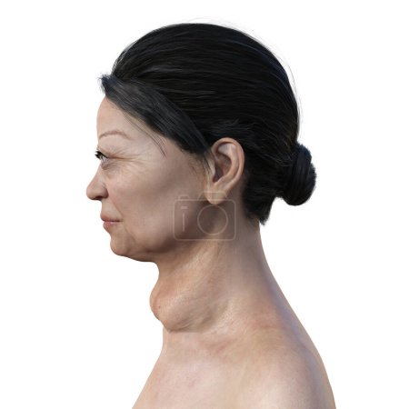 Téléchargez les photos : Une femme atteinte de la maladie de Graves ayant une glande thyroïde élargie et une exophtalmie, illustration 3D. - en image libre de droit