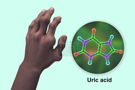 Foto de Ilustración científica en 3D que muestra las manos afectadas por la gota con deformidades y vista de cerca de la molécula de ácido úrico, revelando el impacto destructivo de la deposición crónica de cristales de ácido úrico. - Imagen libre de derechos