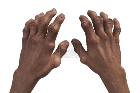 Foto de Ilustración científica en 3D que representa las manos afectadas por la gota con deformidades, revelando el impacto destructivo de la deposición crónica de cristales de ácido úrico. - Imagen libre de derechos