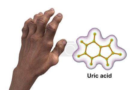 Foto de Ilustración científica en 3D que muestra las manos afectadas por la gota con deformidades y vista de cerca de la molécula de ácido úrico, revelando el impacto destructivo de la deposición crónica de cristales de ácido úrico. - Imagen libre de derechos