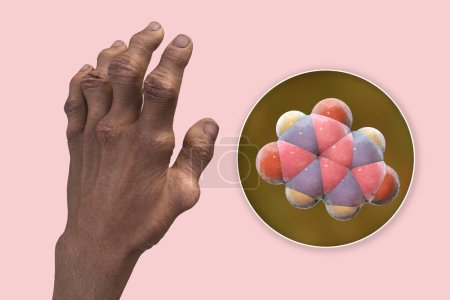 Photo for Scientific 3D illustration depicting gout-afflicted hands with deformities and close-up view of uric acid molecule, revealing the destructive impact of chronic uric acid crystal deposition. - Royalty Free Image