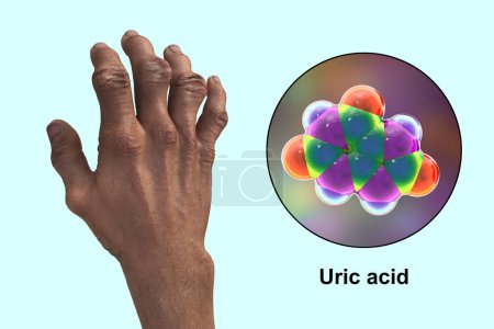 Téléchargez les photos : Illustration 3D scientifique représentant des mains atteintes de goutte avec des difformités et une vue rapprochée de la molécule d'acide urique, révélant l'impact destructeur des dépôts chroniques de cristaux d'acide urique. - en image libre de droit