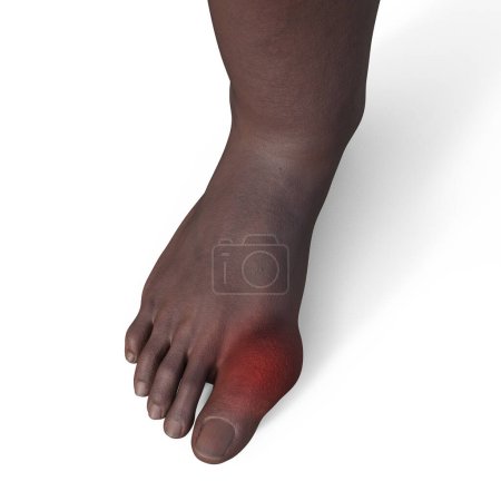 Foto de Ilustración 3D detallada de un pie afectado por gota, mostrando inflamación y deformidad en la articulación del dedo del pie. - Imagen libre de derechos