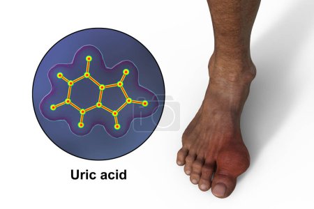 Foto de Ilustración científica en 3D que muestra el pie afectado por la gota y la vista de cerca de la molécula de ácido úrico, revelando el impacto destructivo de la deposición crónica de cristales de ácido úrico. - Imagen libre de derechos