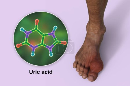 Foto de Ilustración científica en 3D que muestra el pie afectado por la gota y la vista de cerca de la molécula de ácido úrico, revelando el impacto destructivo de la deposición crónica de cristales de ácido úrico. - Imagen libre de derechos