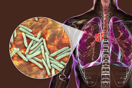 Foto de Tuberculosis pulmonar primaria, ilustración 3D con el complejo Ghon y linfadenitis mediastínica, junto con una visión cercana de la bacteria Mycobacterium tuberculosis. - Imagen libre de derechos