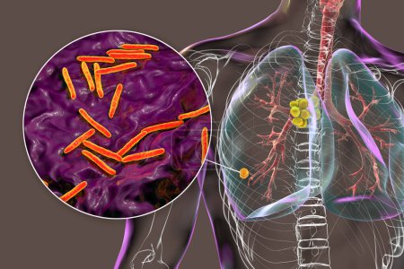 Téléchargez les photos : Tuberculose pulmonaire primaire, illustration 3D du complexe Ghon et lymphadénite médiastinale, avec vue rapprochée de la bactérie Mycobacterium tuberculosis. - en image libre de droit