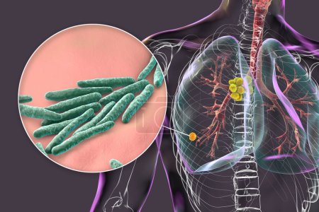 Photo for Primary lung tuberculosis, 3D illustration featuring the Ghon complex and mediastinal lymphadenitis, alongside with close-up view of Mycobacterium tuberculosis bacteria. - Royalty Free Image