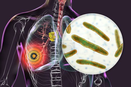 Foto de Tuberculosis pulmonar primaria, ilustración 3D con el complejo Ghon y linfadenitis mediastínica, junto con una visión cercana de la bacteria Mycobacterium tuberculosis. - Imagen libre de derechos