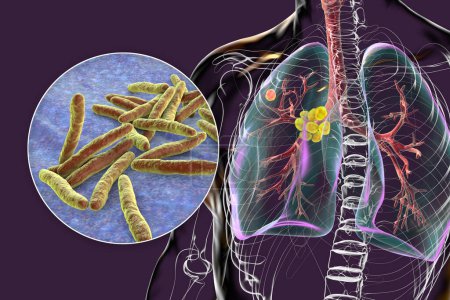 Photo for Primary lung tuberculosis, 3D illustration featuring the Ghon complex and mediastinal lymphadenitis, alongside with close-up view of Mycobacterium tuberculosis bacteria. - Royalty Free Image