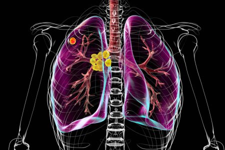 Foto de Tuberculosis pulmonar primaria, ilustración 3D con el complejo Ghon y linfadenitis mediastínica. - Imagen libre de derechos
