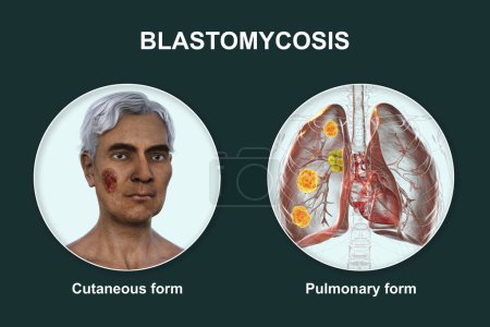 Foto de Formas clínicas de blastomicosis. Blastomicosis cutánea y pulmonar, ilustración 3D. - Imagen libre de derechos