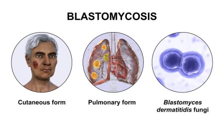 Photo for Clinical forms of blastomycosis. Cutaneous and pulmonary blastomycosis and close-up view of Blastomyces dermatitidis fungi, 3D illustration. - Royalty Free Image