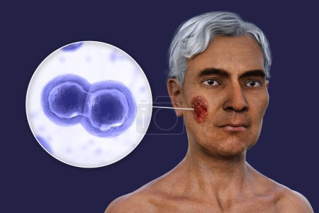 Foto de Ilustración 3D que representa a un hombre con múltiples lesiones en la cara y el cuello, mostrando blastomicosis cutánea, y vista de cerca de los hongos Blastomyces dermatitidis. - Imagen libre de derechos