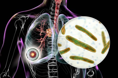 Tuberculose pulmonaire primaire avec le complexe Ranke, illustration 3D mettant en évidence les lésions pulmonaires et la lymphadénite médiastinale, ainsi qu'une vue rapprochée de la bactérie Mycobacterium tuberculosis.