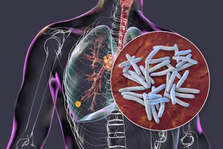Téléchargez les photos : Tuberculose pulmonaire primaire avec le complexe Ranke, illustration 3D mettant en évidence les lésions pulmonaires et la lymphadénite médiastinale, ainsi qu'une vue rapprochée de la bactérie Mycobacterium tuberculosis. - en image libre de droit