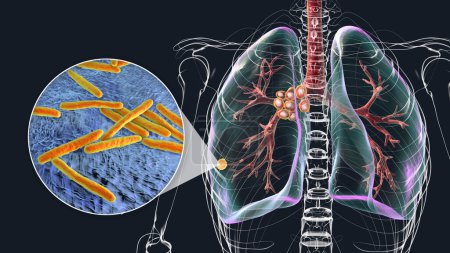 Téléchargez les photos : Tuberculose pulmonaire primaire avec le complexe Ranke, illustration 3D mettant en évidence les lésions pulmonaires et la lymphadénite médiastinale, ainsi qu'une vue rapprochée de la bactérie Mycobacterium tuberculosis. - en image libre de droit