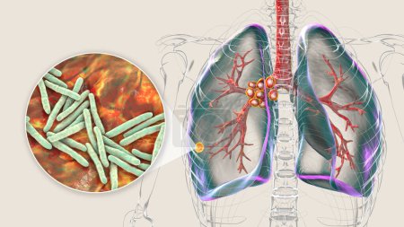 Foto de Tuberculosis pulmonar primaria con el complejo Ranke, ilustración 3D que destaca lesiones pulmonares y linfadenitis mediastínica, junto con una visión cercana de la bacteria Mycobacterium tuberculosis. - Imagen libre de derechos