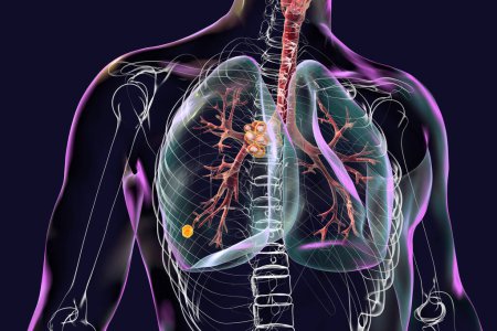 Téléchargez les photos : Tuberculose pulmonaire primaire avec le complexe Ranke, illustration 3D mettant en évidence les lésions pulmonaires et la lymphadénite médiastinale. - en image libre de droit