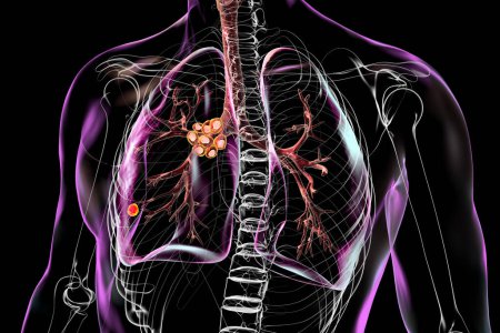 Tuberculose pulmonaire primaire avec le complexe Ranke, illustration 3D mettant en évidence les lésions pulmonaires et la lymphadénite médiastinale.