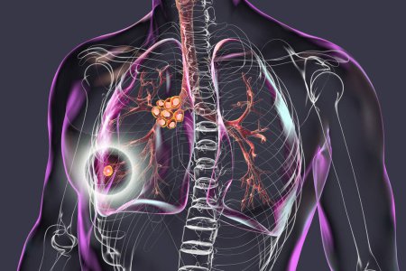 Foto de Tuberculosis pulmonar primaria con el complejo Ranke, ilustración 3D que destaca lesiones pulmonares y linfadenitis mediastínica. - Imagen libre de derechos